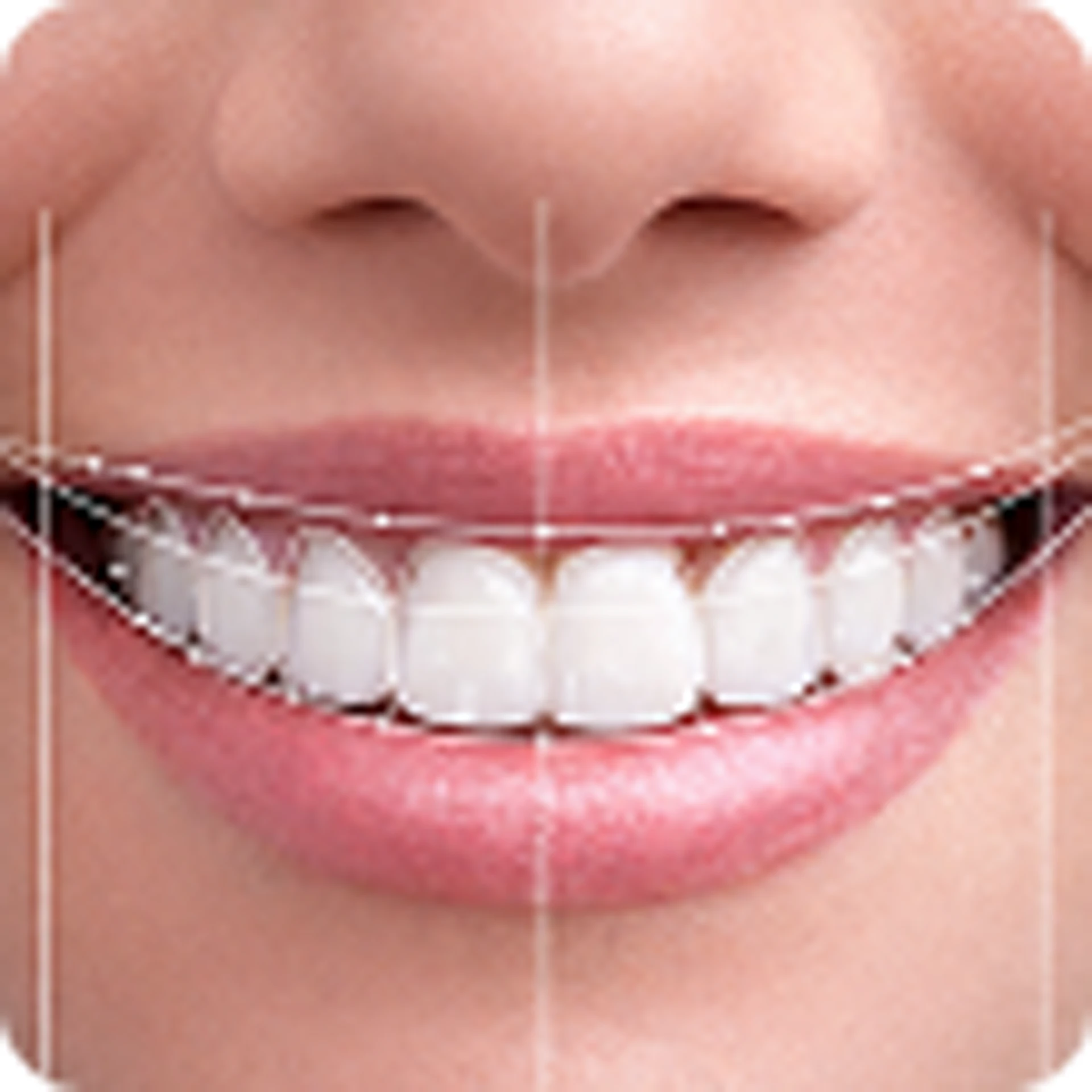 Smile Makeover