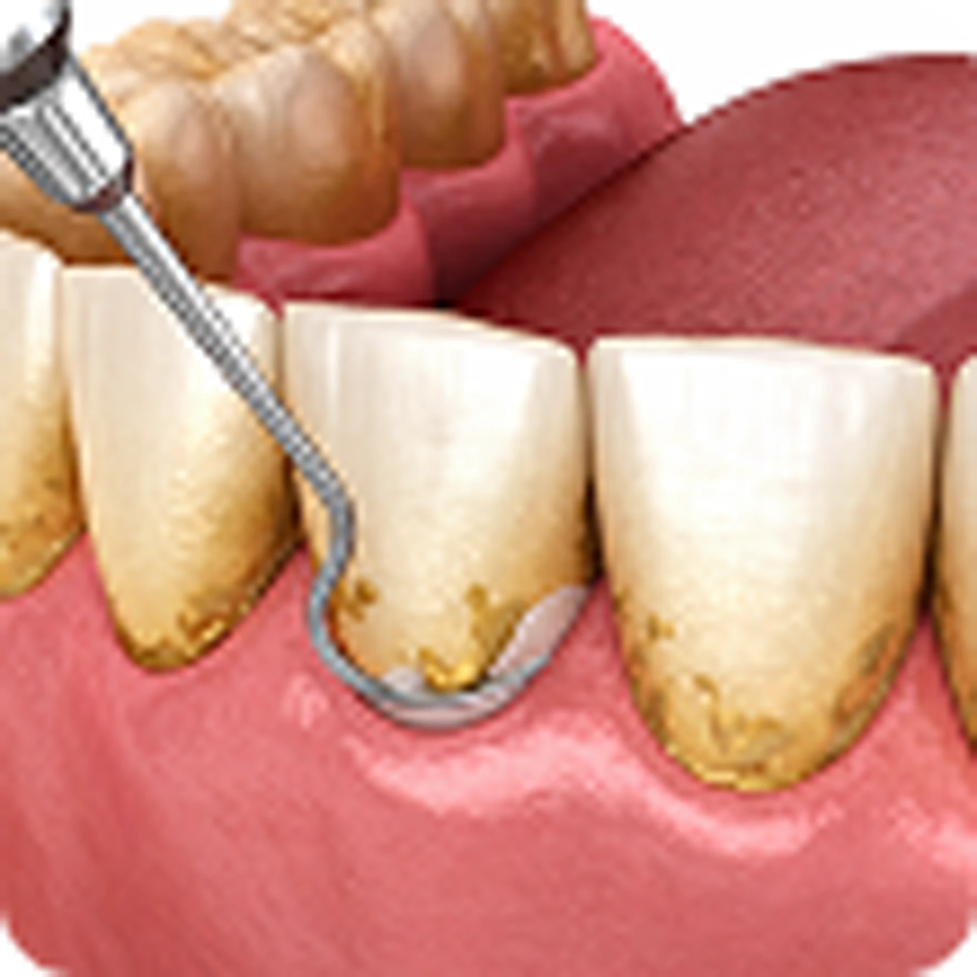 Gum Disease Treatment