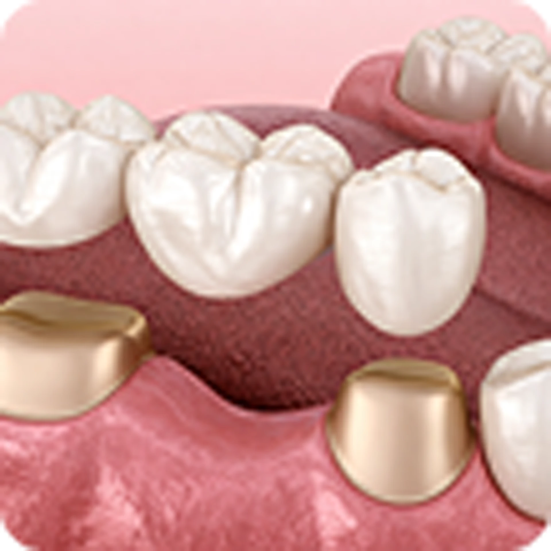 Dental Crowns & Bridges